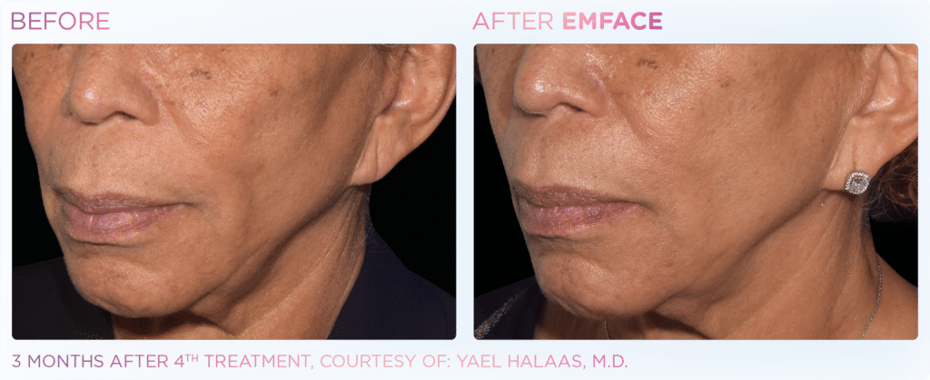 before and after Facial Rejuvenation Downriver MI