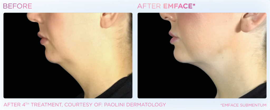 before and after Emface Facial Rejuvenation Downriver MI